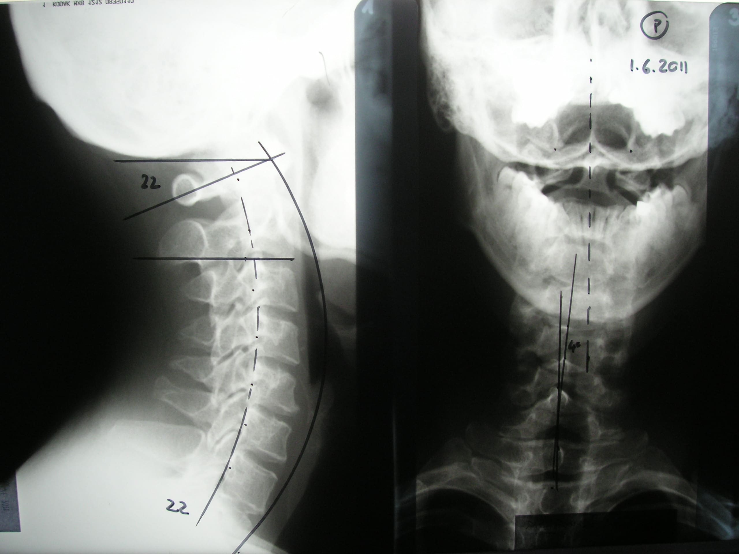 chiropraktyka Pierca mierzenie kręgosłupa szyjnego bok i oś czaszki 