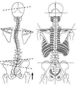 skolioza skrzywienie kręgosłupa i prosty kręgosłup